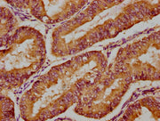 IHC image of CSB-PA622675HA01HU diluted at 1:300 and staining in paraffin-embedded human endometrial cancer performed on a Leica BondTM system. After dewaxing and hydration, antigen retrieval was mediated by high pressure in a citrate buffer (pH 6...