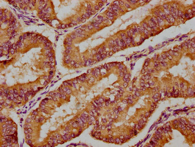 IHC image of CSB-PA622675HA01HU diluted at 1:300 and staining in paraffin-embedded human endometrial cancer performed on a Leica BondTM system. After dewaxing and hydration, antigen retrieval was mediated by high pressure in a citrate buffer (pH 6...