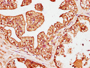 IHC image of CSB-PA622689LA01HU diluted at 1:200 and staining in paraffin-embedded human prostate cancer performed on a Leica BondTM system. After dewaxing and hydration, antigen retrieval was mediated by high pressure in a citrate buffer (pH 6.0)...