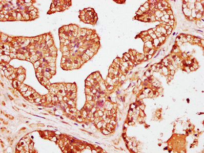 IHC image of CSB-PA622689LA01HU diluted at 1:200 and staining in paraffin-embedded human prostate cancer performed on a Leica BondTM system. After dewaxing and hydration, antigen retrieval was mediated by high pressure in a citrate buffer (pH 6.0)...