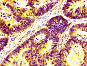 IHC image of CSB-PA622754LA01HU diluted at 1:400 and staining in paraffin-embedded human ovarian cancer performed on a Leica BondTM system. After dewaxing and hydration, antigen retrieval was mediated by high pressure in a citrate buffer (pH 6.0)....