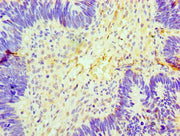 Immunohistochemistry of paraffin-embedded human ovarian cancer using CSB-PA622767LA01HU at dilution of 1:100
