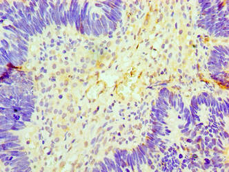 Immunohistochemistry of paraffin-embedded human ovarian cancer using CSB-PA622767LA01HU at dilution of 1:100
