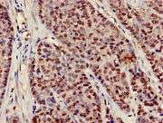 Immunohistochemistry of paraffin-embedded human ovarian cancer using CSB-PA622771LA01HU at dilution of 1:100