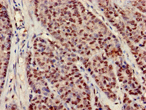 Immunohistochemistry of paraffin-embedded human ovarian cancer using CSB-PA622771LA01HU at dilution of 1:100