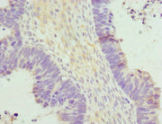 Immunohistochemistry of paraffin-embedded human ovarian cancer using CSB-PA622984ESR1HU at dilution of 1:100