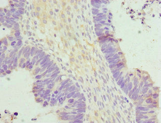 Immunohistochemistry of paraffin-embedded human ovarian cancer using CSB-PA622984ESR1HU at dilution of 1:100