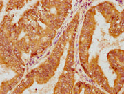 IHC image of CSB-PA622993LA01HU diluted at 1:100 and staining in paraffin-embedded human endometrial cancer performed on a Leica BondTM system. After dewaxing and hydration, antigen retrieval was mediated by high pressure in a citrate buffer (pH 6...