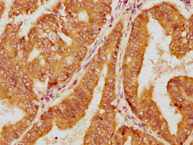 IHC image of CSB-PA622993LA01HU diluted at 1:100 and staining in paraffin-embedded human endometrial cancer performed on a Leica BondTM system. After dewaxing and hydration, antigen retrieval was mediated by high pressure in a citrate buffer (pH 6...