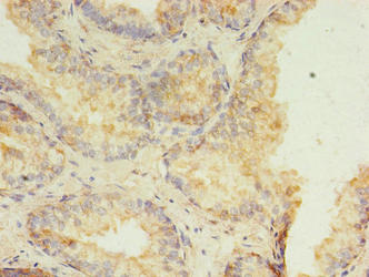 Immunohistochemistry of paraffin-embedded human prostate cancer using CSB-PA623009LA01HU at dilution of 1:100