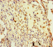Immunohistochemistry of paraffin-embedded human lung cancer using CSB-PA623092HA01HU at dilution of 1: 100