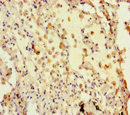 Immunohistochemistry of paraffin-embedded human lung cancer using CSB-PA623092HA01HU at dilution of 1: 100