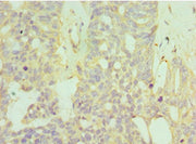 Immunohistochemistry of paraffin-embedded human endommetrial cancer using CSB-PA623651ESR1HU at dilution of 1:100