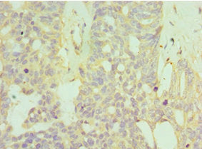 Immunohistochemistry of paraffin-embedded human endommetrial cancer using CSB-PA623651ESR1HU at dilution of 1:100