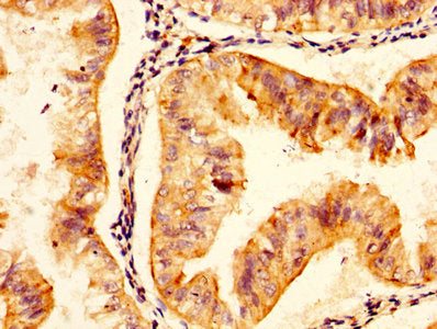 IHC image of CSB-PA623799LA01HU diluted at 1:300 and staining in paraffin-embedded human endometrial cancer performed on a Leica BondTM system. After dewaxing and hydration, antigen retrieval was mediated by high pressure in a citrate buffer (pH 6...