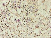 Immunohistochemistry of paraffin-embedded human breast cancer using CSB-PA623829ESR1HU at dilution of 1:100