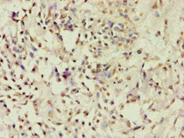 Immunohistochemistry of paraffin-embedded human breast cancer using CSB-PA623829ESR1HU at dilution of 1:100