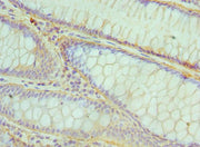 Immunohistochemistry of paraffin-embedded human colon cancer using CSB-PA623835ESR1HU at dilution of 1:100