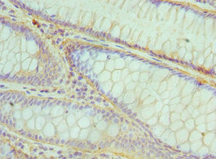 Immunohistochemistry of paraffin-embedded human colon cancer using CSB-PA623835ESR1HU at dilution of 1:100