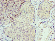 Immunohistochemistry of paraffin-embedded human cervical cancer using CSB-PA623902ESR1HU at dilution of 1:100