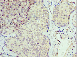 Immunohistochemistry of paraffin-embedded human cervical cancer using CSB-PA623902ESR1HU at dilution of 1:100