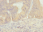 Immunohistochemistry of paraffin-embedded human prostate cancer using CSB-PA623910ESR1HU at dilution of 1:100