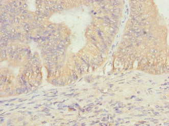 Immunohistochemistry of paraffin-embedded human prostate cancer using CSB-PA623910ESR1HU at dilution of 1:100