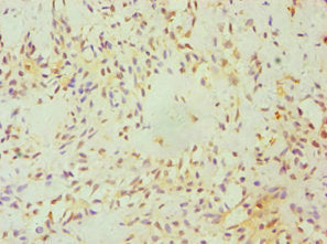 Immunohistochemistry of paraffin-embedded human breast cancer using CSB-PA623920ESR1HU at dilution of 1:100