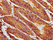 IHC image of CSB-PA623921LA01HU diluted at 1:400 and staining in paraffin-embedded human endometrial cancer performed on a Leica BondTM system. After dewaxing and hydration, antigen retrieval was mediated by high pressure in a citrate buffer (pH 6...