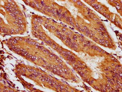 IHC image of CSB-PA623921LA01HU diluted at 1:400 and staining in paraffin-embedded human endometrial cancer performed on a Leica BondTM system. After dewaxing and hydration, antigen retrieval was mediated by high pressure in a citrate buffer (pH 6...