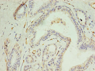Immunohistochemistry of paraffin-embedded human breast cancer using CSB-PA623930LA01HU at dilution of 1:100