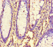 Immunohistochemistry of paraffin-embedded human colon cancer using CSB-PA624022LA01HU at dilution of 1:100