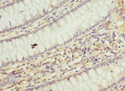 Immunohistochemistry of paraffin-embedded human colon cancer using CSB-PA624102ESR1HU at dilution of 1:100