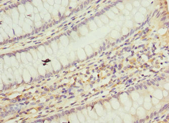 Immunohistochemistry of paraffin-embedded human colon cancer using CSB-PA624102ESR1HU at dilution of 1:100