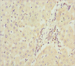Immunohistochemistry of paraffin-embedded human liver cancer using CSB-PA624119ESR1HU at dilution of 1:100