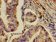 Immunohistochemistry of paraffin-embedded human endometrial cancer using CSB-PA624122LA01HU at dilution of 1:100
