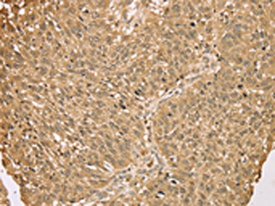 The image on the left is immunohistochemistry of paraffin-embedded Human lung cancer tissue using CSB-PA625010(S100A11 Antibody) at dilution 1/25, on the right is treated with fusion protein. (Original magnification: ×200)