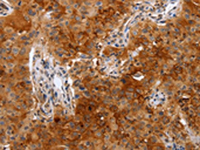 The image on the left is immunohistochemistry of paraffin-embedded Human lung cancer tissue using CSB-PA628429(PLAUR Antibody) at dilution 1/50, on the right is treated with fusion protein. (Original magnification: ×200)