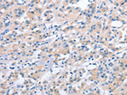 The image on the left is immunohistochemistry of paraffin-embedded Human thyroid cancer tissue using CSB-PA628649(NCAPD2 Antibody) at dilution 1/40, on the right is treated with fusion protein. (Original magnification: ×200)