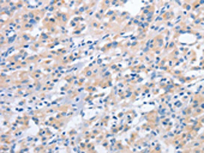 The image on the left is immunohistochemistry of paraffin-embedded Human thyroid cancer tissue using CSB-PA628649(NCAPD2 Antibody) at dilution 1/40, on the right is treated with fusion protein. (Original magnification: ×200)