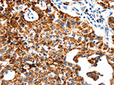 The image on the left is immunohistochemistry of paraffin-embedded Human lung cancer tissue using CSB-PA630217(SLC2A1 Antibody) at dilution 1/50, on the right is treated with synthetic peptide. (Original magnification: ×200)