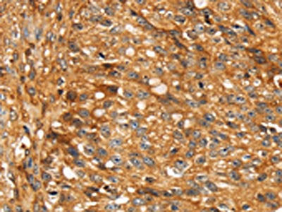 The image on the left is immunohistochemistry of paraffin-embedded Human breast cancer tissue using CSB-PA631492(STC1 Antibody) at dilution 1/20, on the right is treated with fusion protein. (Original magnification: ×200)