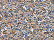 The image on the left is immunohistochemistry of paraffin-embedded Human liver cancer tissue using CSB-PA632606(DNMT3A Antibody) at dilution 1/50, on the right is treated with fusion protein. (Original magnification: ×200)