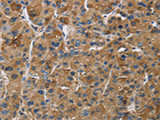 The image on the left is immunohistochemistry of paraffin-embedded Human liver cancer tissue using CSB-PA632749(IGF2R Antibody) at dilution 1/50, on the right is treated with synthetic peptide. (Original magnification: ×200)