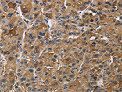The image on the left is immunohistochemistry of paraffin-embedded Human liver cancer tissue using CSB-PA632749(IGF2R Antibody) at dilution 1/50, on the right is treated with synthetic peptide. (Original magnification: ×200)