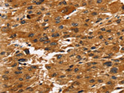 The image on the left is immunohistochemistry of paraffin-embedded Human liver cancer tissue using CSB-PA633214(TACC2 Antibody) at dilution 1/30, on the right is treated with synthetic peptide. (Original magnification: ×200)