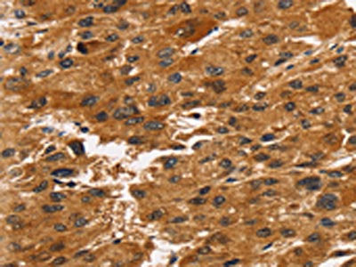 The image on the left is immunohistochemistry of paraffin-embedded Human liver cancer tissue using CSB-PA633214(TACC2 Antibody) at dilution 1/30, on the right is treated with synthetic peptide. (Original magnification: ×200)