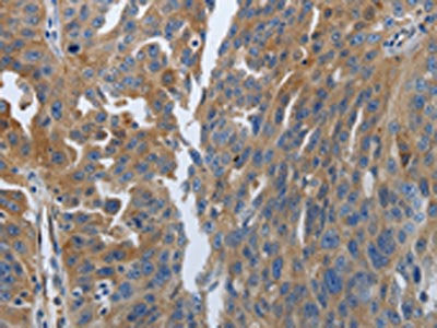 The image on the left is immunohistochemistry of paraffin-embedded Human ovarian cancer tissue using CSB-PA634030(SOCS1 Antibody) at dilution 1/70, on the right is treated with synthetic peptide. (Original magnification: ×200)