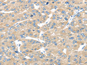 The image on the left is immunohistochemistry of paraffin-embedded Human liver cancer tissue using CSB-PA634052(TRAK1 Antibody) at dilution 1/25, on the right is treated with fusion protein. (Original magnification: ×200)