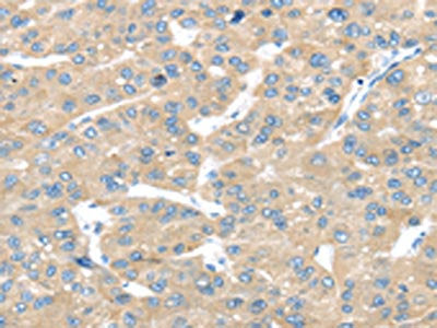 The image on the left is immunohistochemistry of paraffin-embedded Human liver cancer tissue using CSB-PA634052(TRAK1 Antibody) at dilution 1/25, on the right is treated with fusion protein. (Original magnification: ×200)